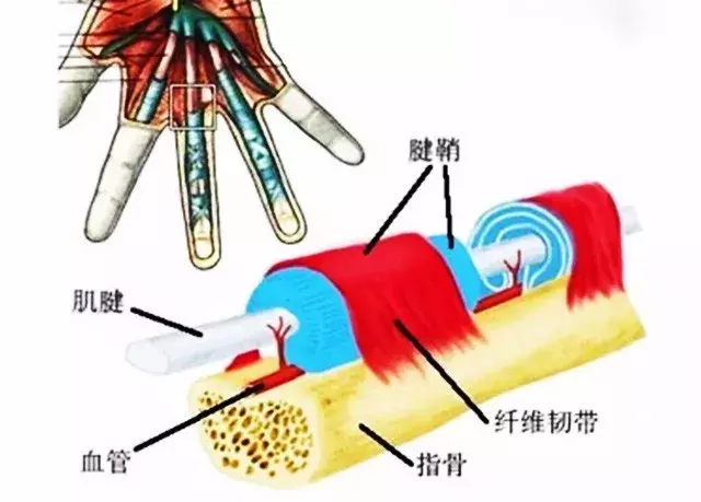 腱鞘炎怎么办?治疗其实很简单