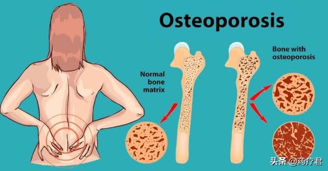 骨质疏松可不是什么老年病，补钙存骨再晚不要晚过这个年纪
