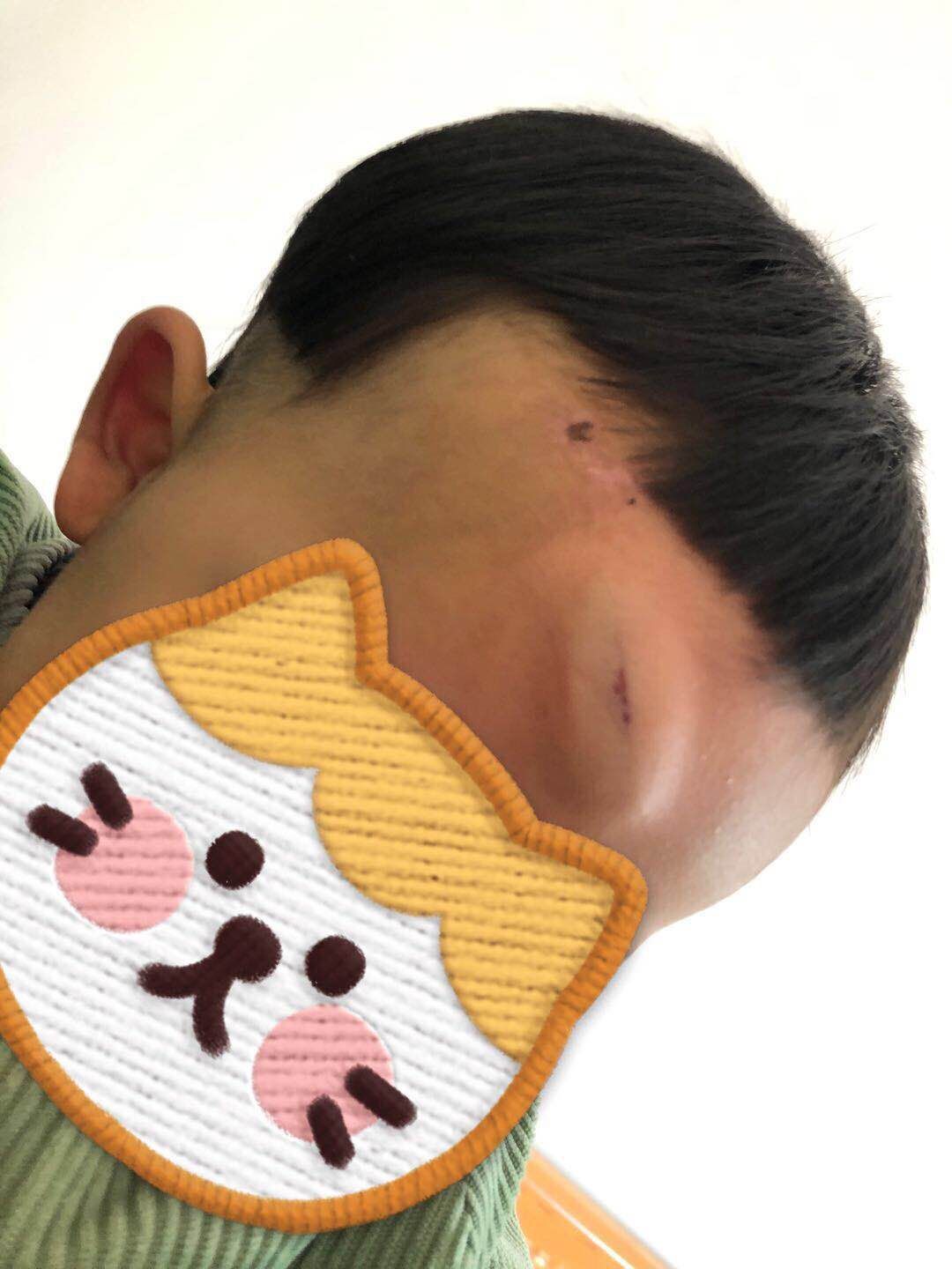 婴儿摔下床头肿了个包(宝宝坠床后) - 乐宝宝贝