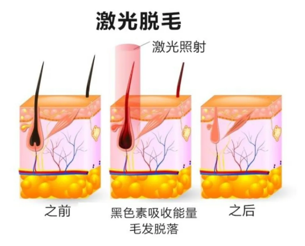 盘点脱毛仪3大“骗局”，逐一拆穿别被坑，教你正确打开方式