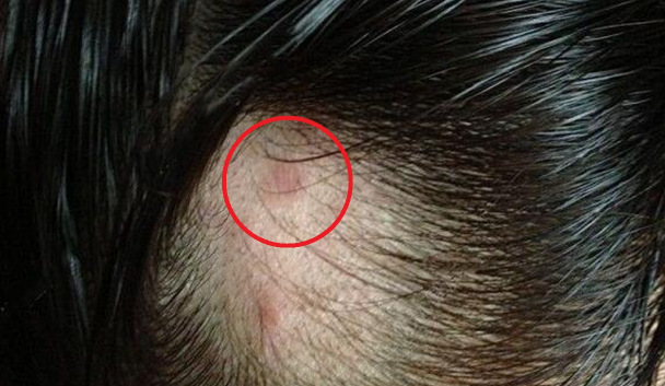 头发有螨虫怎么去除(头皮如何除螨)