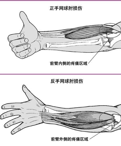 拔火罐能治网球肘吗(网球肘，不可怕，及时休息是关键)