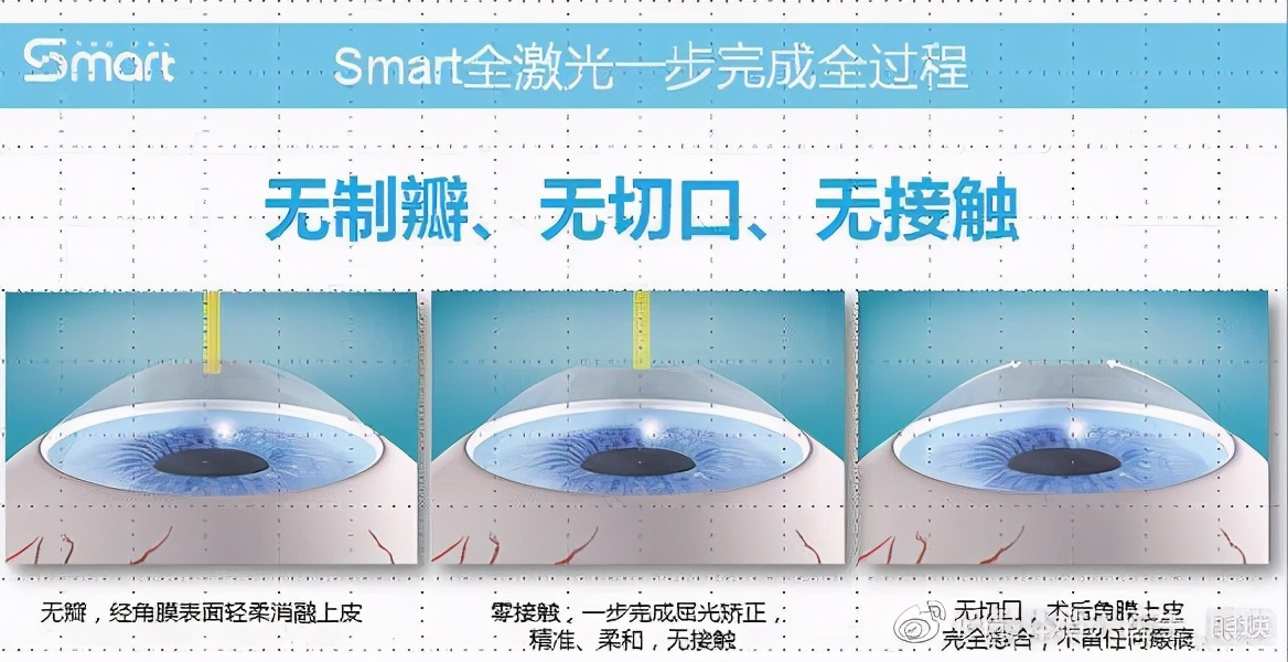 高考升学体检将至，你还在纠结选择哪种手术吗？