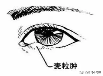眼疖子治疗方法及注意事项（麦粒肿切忌挤压）
