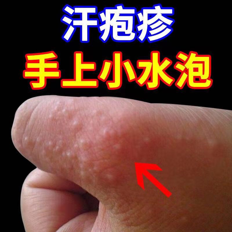 手指缝、脚趾缝、脚底板总长透明小水泡，很痒总想抠？一文说清