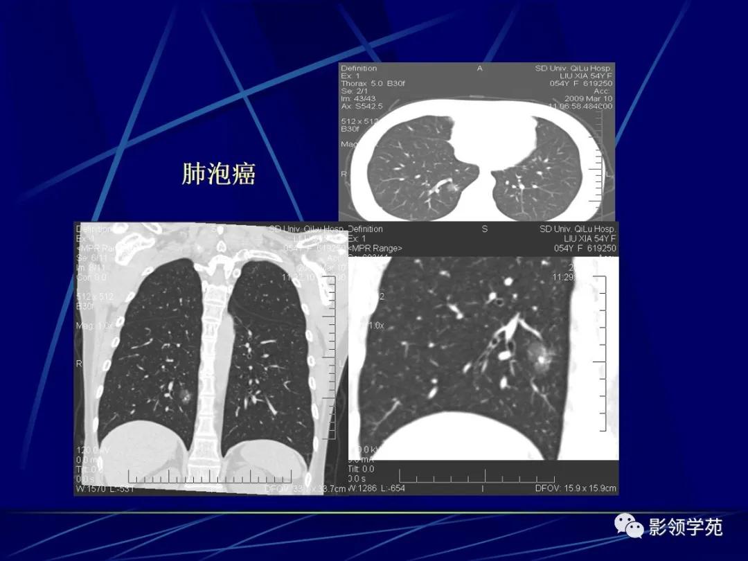 肺小结节影像诊断