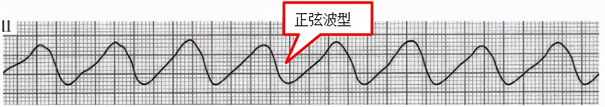 掌握常见心电图，我的心脏我做主