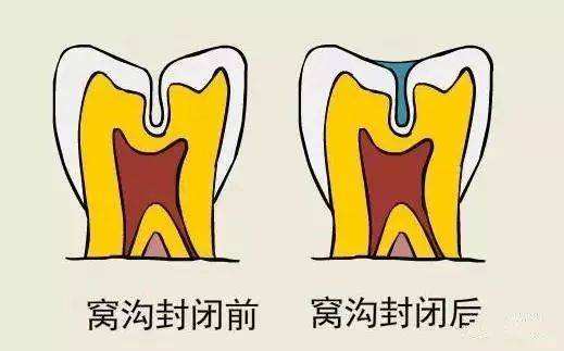 儿童预防龋齿能做窝沟封闭吗？几岁可以做？家长想知道的都在这里