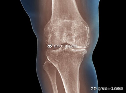 「运动康复科普」关节积液的出现机制与康复治疗