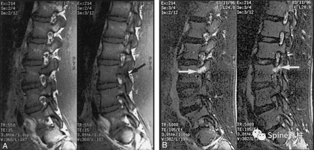 从诊断到治疗：全面解析腰椎峡部裂(lumbar spondylolysis)