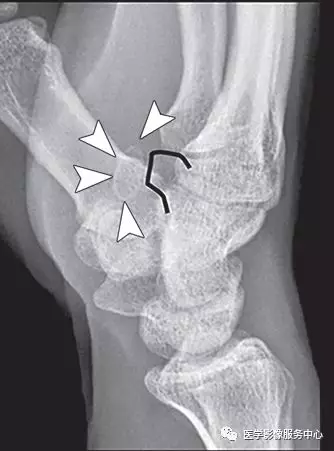 21种手腕部撕脱骨折及损伤