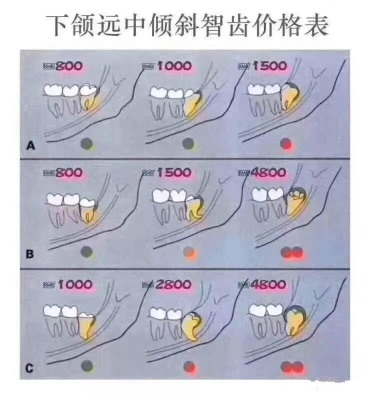 为啥拔智齿收费差别这么大？看了这3张图你就明白了