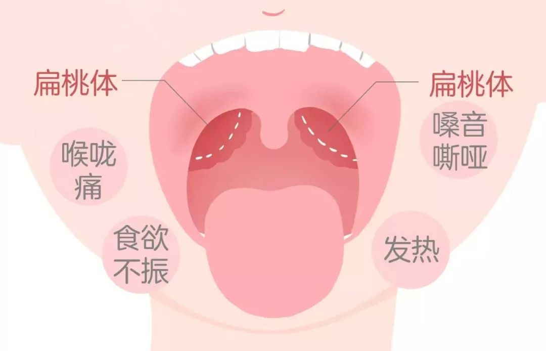 别拿扁桃体发炎不当回事?扁桃体发炎、上火了怎么治