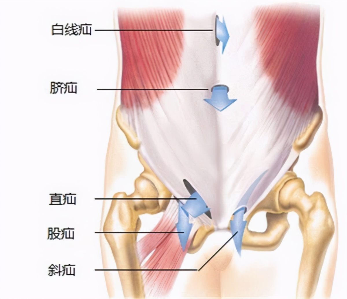 腹股沟具体位置图片