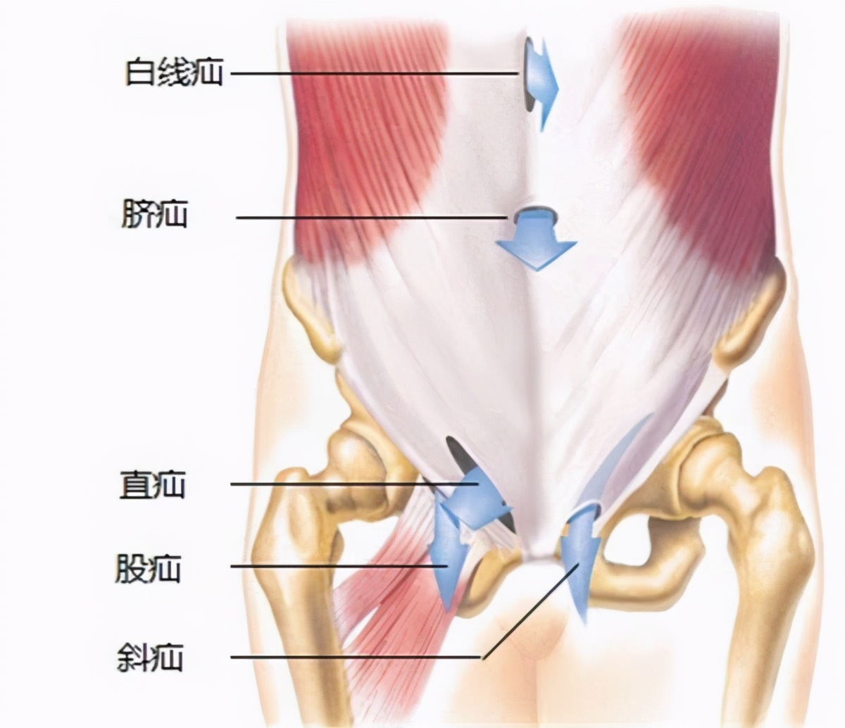 嵌顿,绞窄性疝一般腹股沟疝斜疝会有这样的情况,大