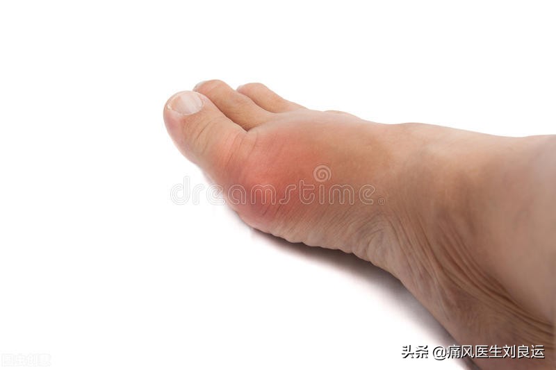 痛风急性发作为何常表现为大脚趾疼痛？
