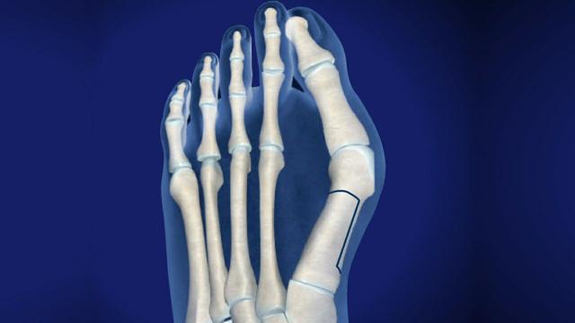 大脚拐,大脚趾内侧疼痛,要警惕:拇(趾)外翻,拇囊炎