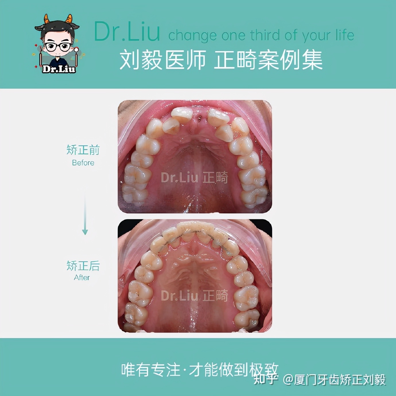 厦门牙齿矫正：「牙列稀疏复杂案例」