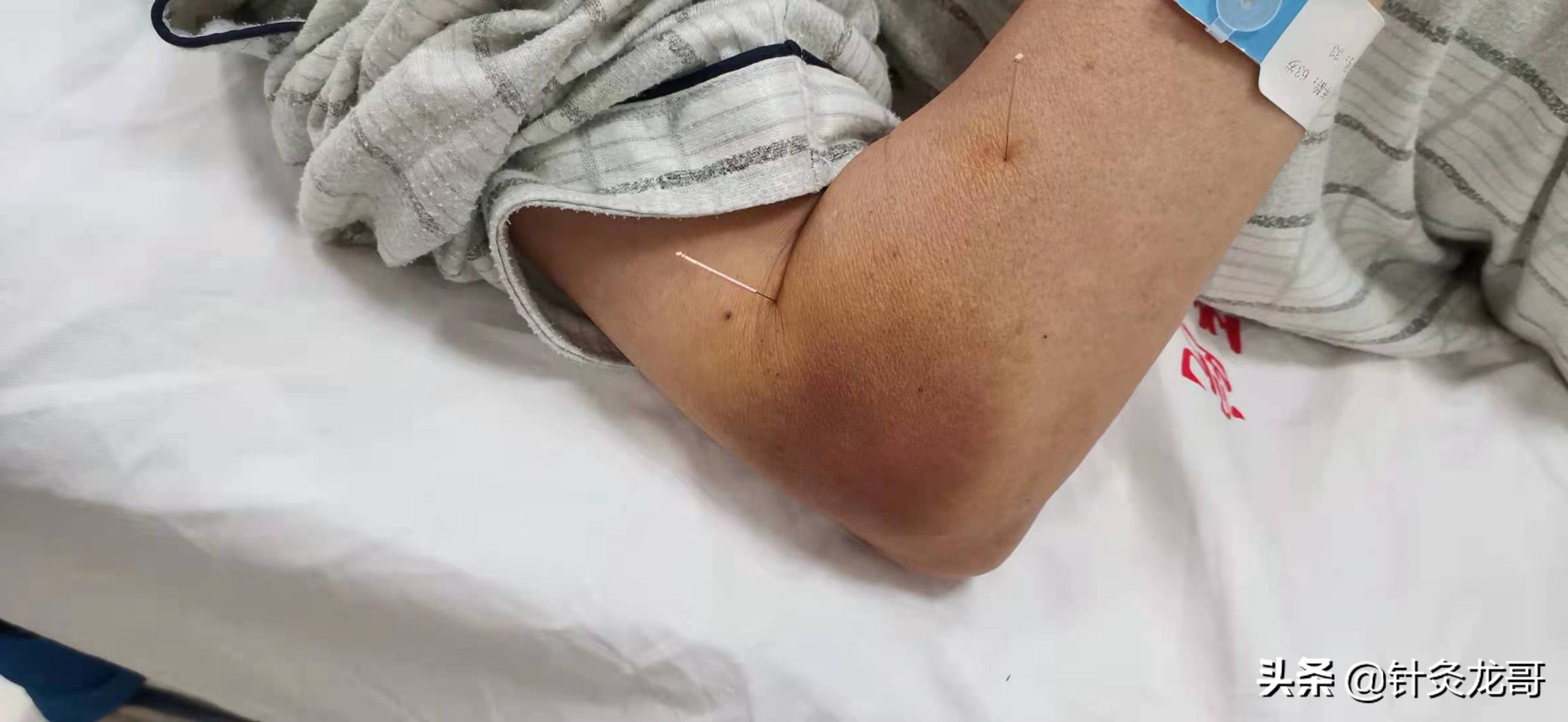 所以,要想避免针刺出血,首先,得基本专业知识过硬,熟悉针刺穴位的解剖