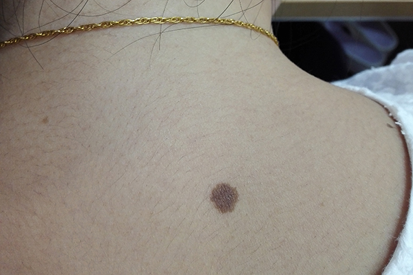 皮肤上的黑痣皮肤上的黑痣图片