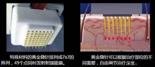 毛孔粗大十几年？别怕，还有救