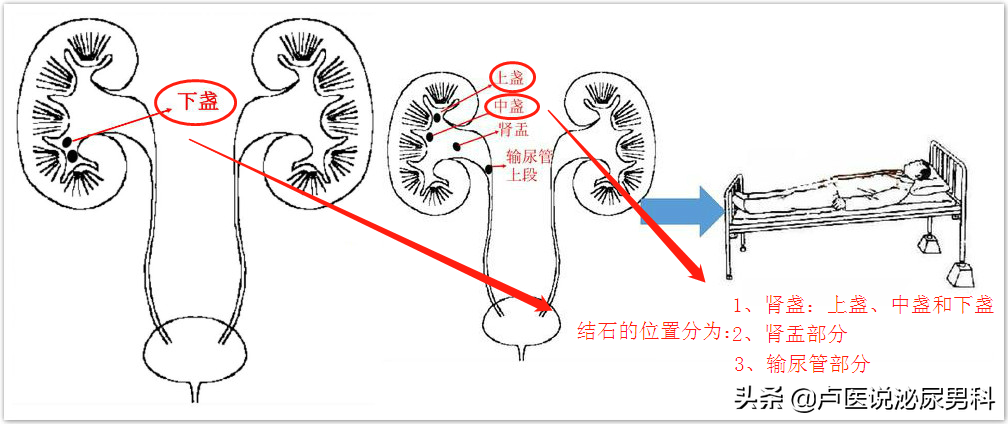 如果你患有尿路结石，准备通过“体外冲击波碎石”治疗，请看此文