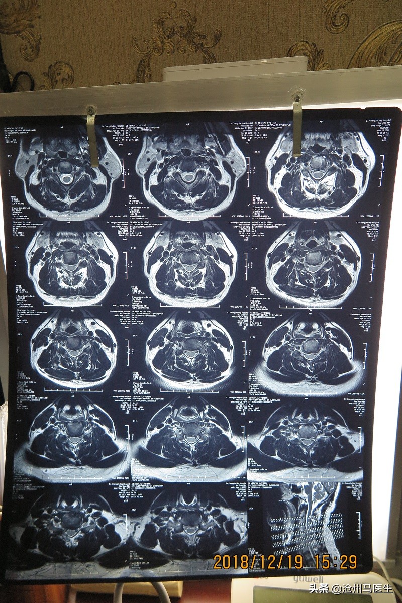 天旋地转，眩晕恶心、呕吐、心慌的中医治疗病例报告分析