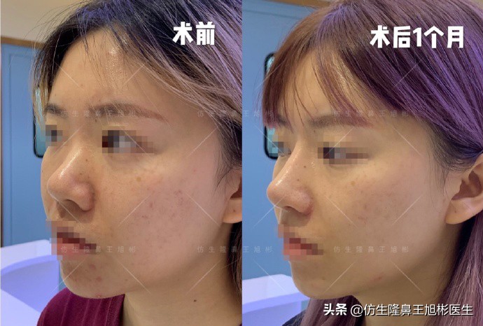 如何定义短鼻，短鼻延长后的改变有多大？