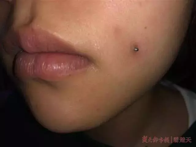 19岁女孩自愿在脸上打2颗钢钉,目的让人无法理解
