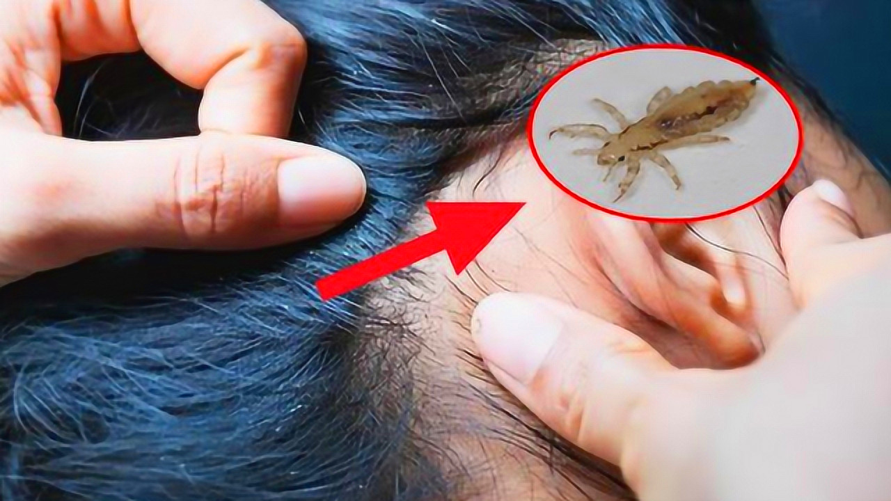 头发虱子图片(同人类共进化) - 赤虎壹号