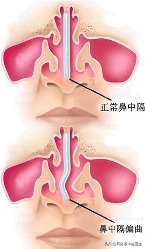 鼻中隔偏曲是怎么回事？