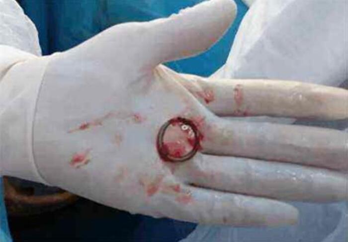 正是体内的埋藏多年的节育环,在正常情况下,取出节育环只需要将工具