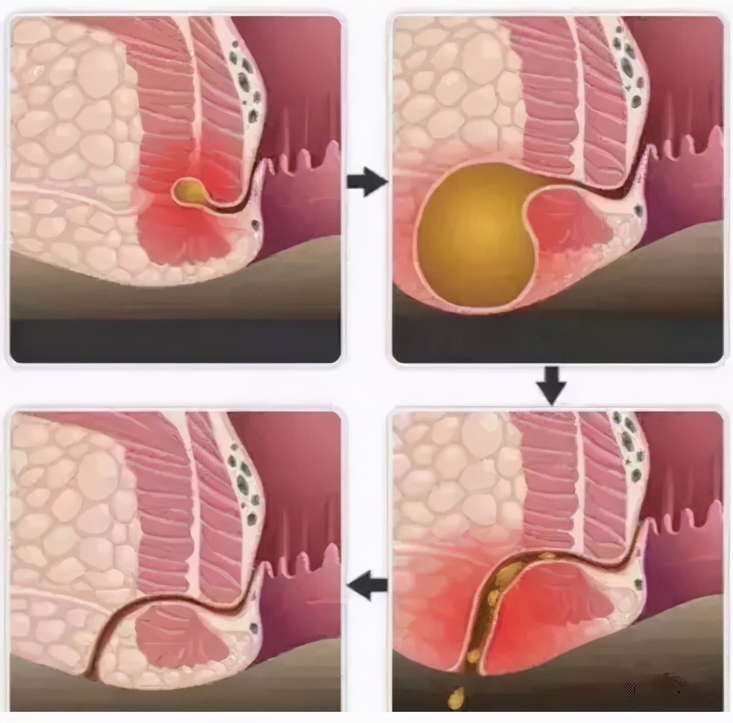 婴儿肛瘘的症状图片(肛肠科患者与医生的真实对话) - 乐宝宝贝