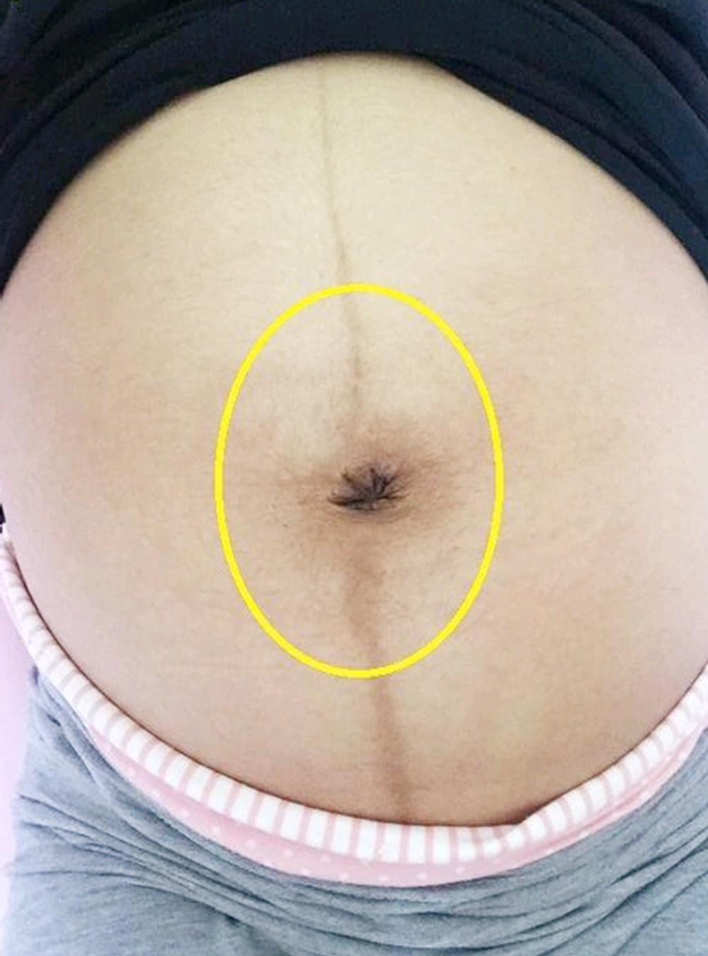 孕妈怀孕后,肚脐也发生了变化,“凸”出来的原因无外乎三种