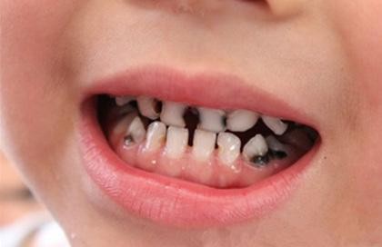 90%的孩子都有蛀牙：别再让孩子补牙，这个方法更有效