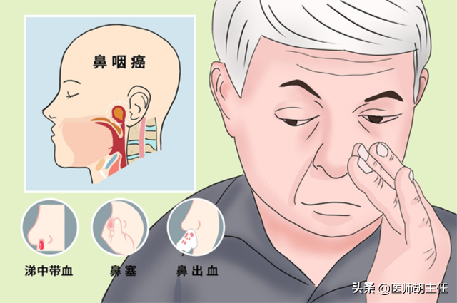 鼻咽癌来临前,身体会先经历3个症状!发现1个,建议及早就医检查