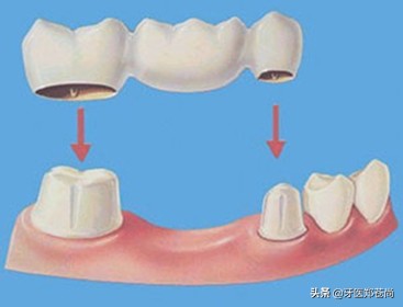 缺一颗牙为什么要做三颗假牙？患者有两颗缺失牙