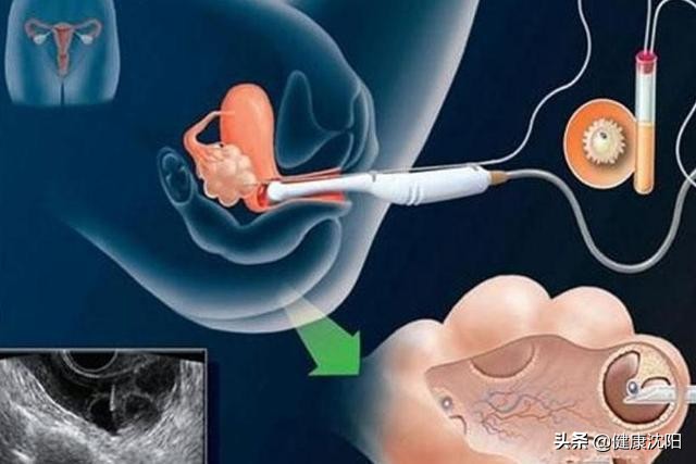 健康科普堂 | 肚子疼流血都查它，阴式超声到底有多神？