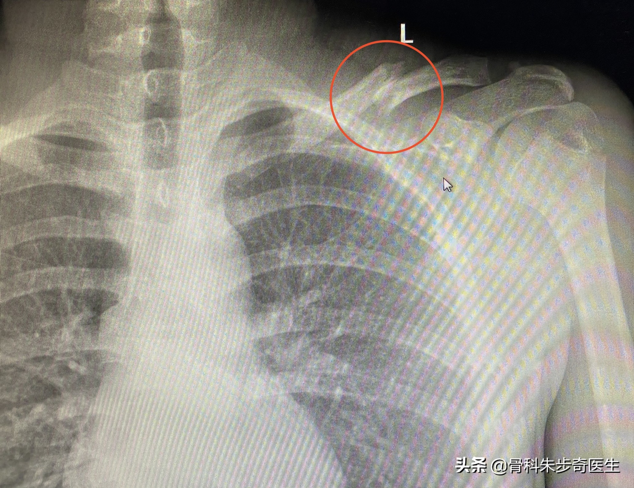 患者故事：锁骨骨折对于孩子来说，90%以上都不用手术