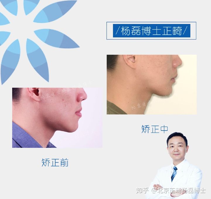 北京正畸杨磊博士：骨性反颌偏颌患者
