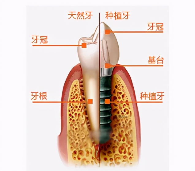 牙齿缺失尽量别做烤瓷牙，少花冤枉钱