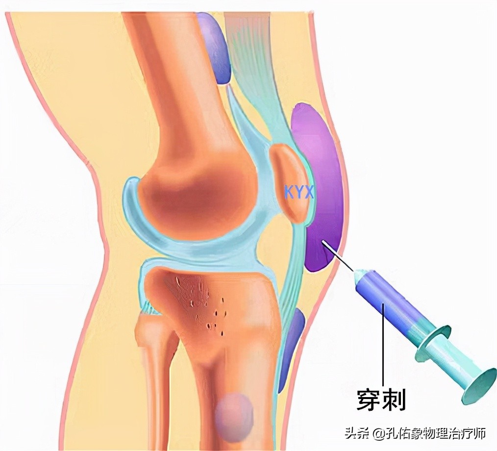 膝关节肿胀、积液、还伴疼痛，是啥原因引发的？该咋办？请看此文