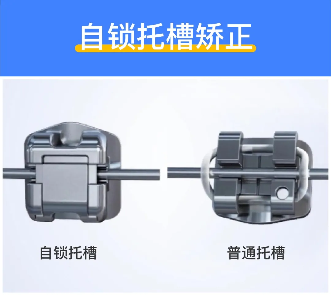 深度揭秘:牙齿矫正到底需要多少钱?