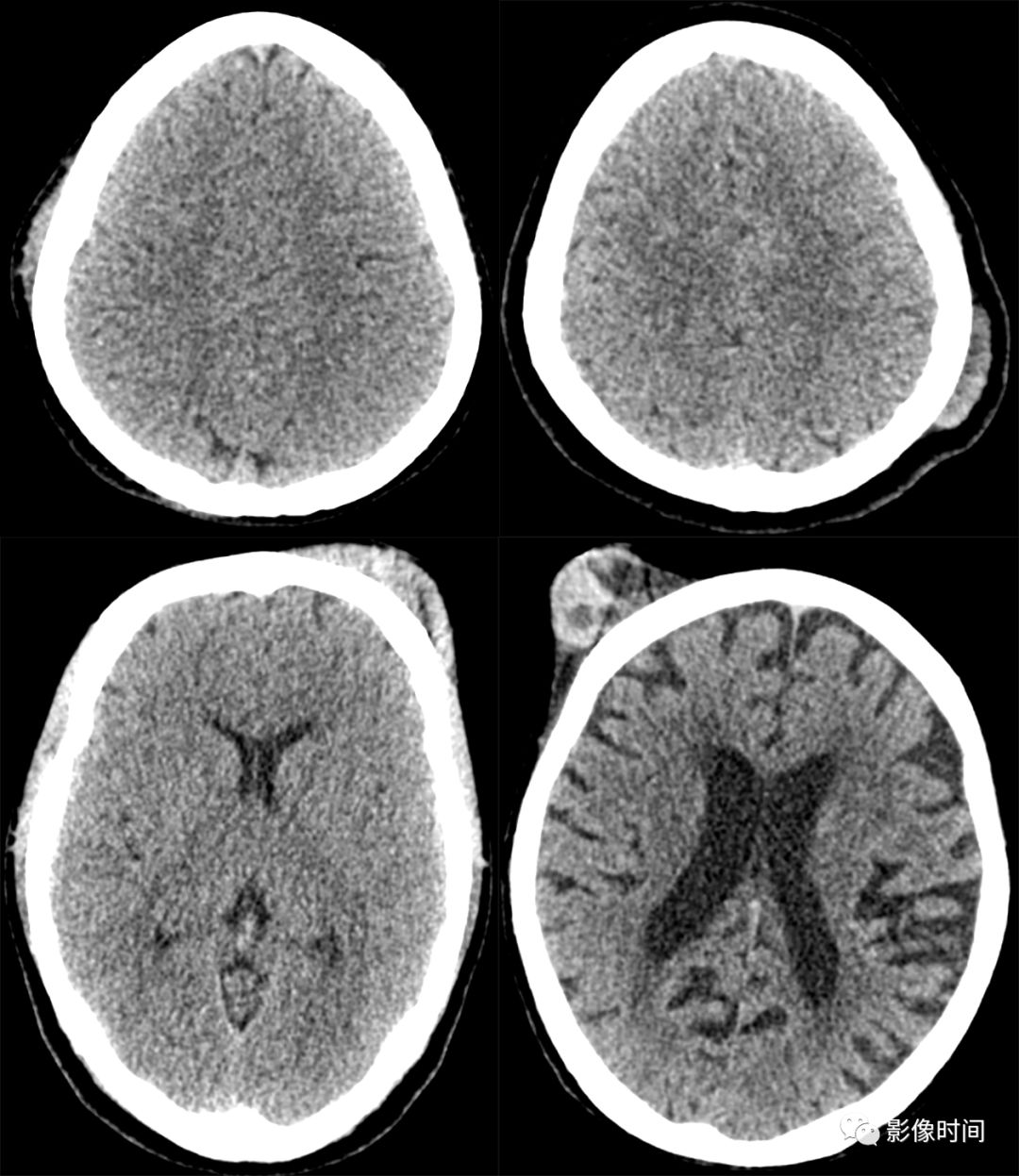 颅脑外伤的急诊 CT 表现
