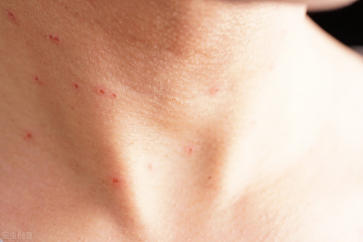 初期小疣体图片 hpv是怎么感染上的-文化号