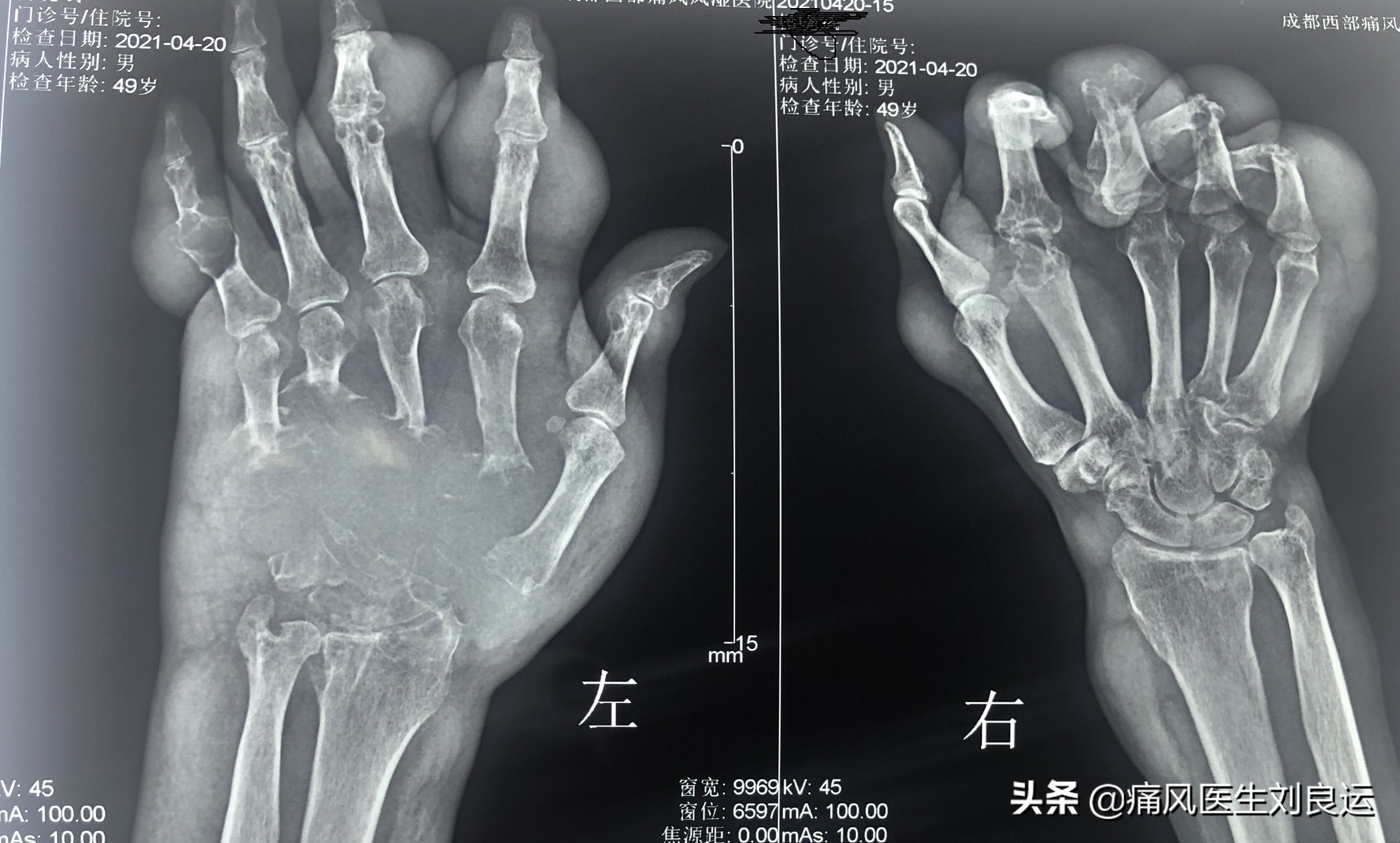 饮食清淡却患上痛风这种“富贵病”，26岁小伙用针挑破痛风石