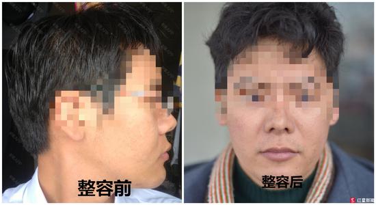 男子花1.2万隆鼻后竟能晃动，美容院：这是正常误差范围