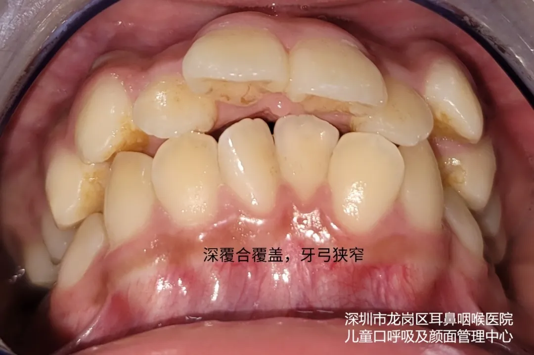 长期张嘴呼吸面容图片(用嘴呼吸坏习惯毁颜值)