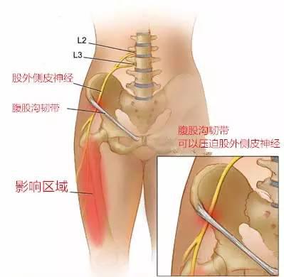 她腹股沟痛、大腿外侧麻半年多，却不是腰椎间盘突出引起的