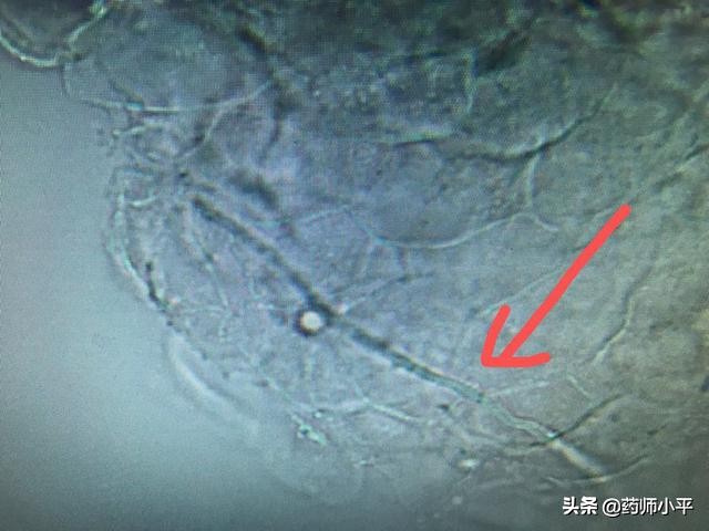 内裤和袜子放在一起洗导致股癣怎么办？4个建议，让你远离股癣